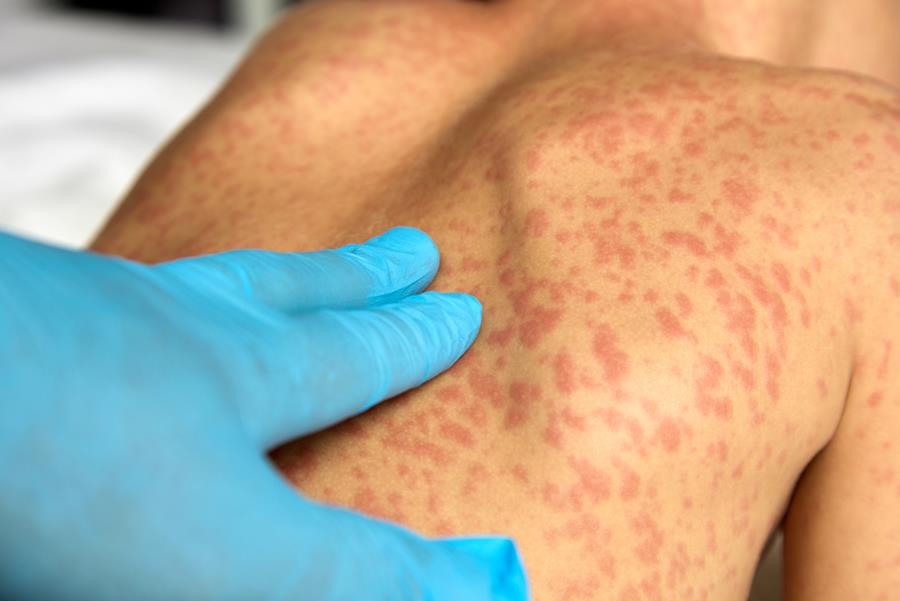 Flambée de rougeole dans le nord-est de Londres