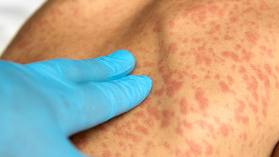 Uitbraak van mazelen in noordoosten van Londen