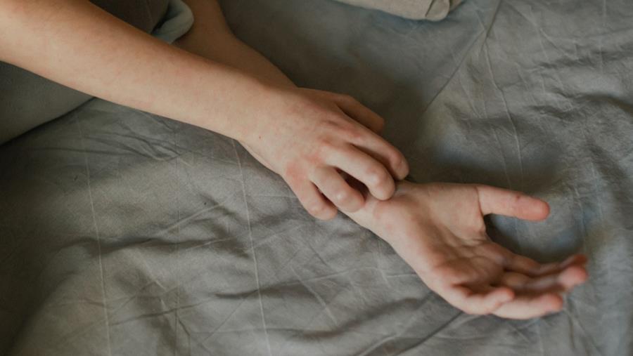 Gale sévère : faut-il augmenter les doses d’ivermectine?