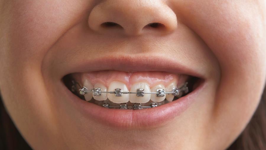 Un plafond annuel pour rendre l’orthodontie plus accessible